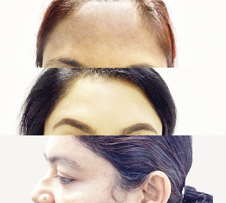 BOTOX in Bangladesh 2 VitaSkin_Botox_Treatment_After