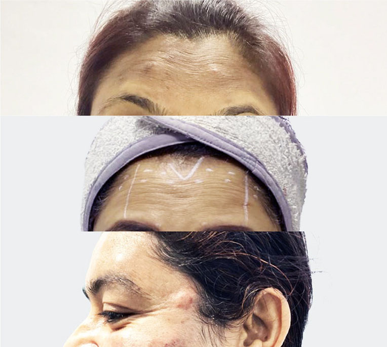 BOTOX in Bangladesh 1 Botox treatment Before