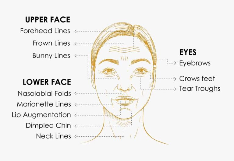 BOTOX in Bangladesh 6 Botox Injection Face Map. Here we can see how VitaSkin Botox Treatment In Bangladesh Can Fight All Your Ageing Concerns